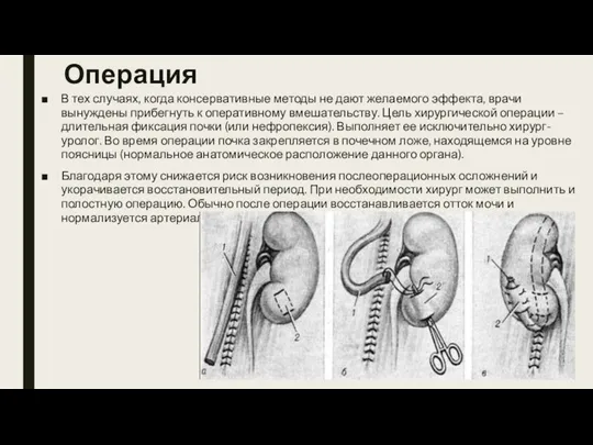 Операция В тех случаях, когда консервативные методы не дают желаемого эффекта, врачи