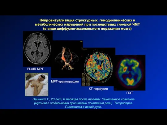 КТ-перфузия МРТ-трактография ПЭТ FLAIR МРТ Нейровизуализация структурных, гемодинамических и метаболических нарушений при
