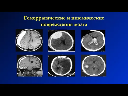 Геморрагические и ишемические повреждения мозга