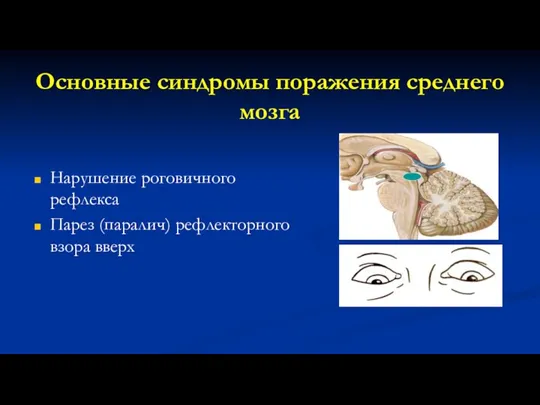 Основные синдромы поражения среднего мозга Нарушение роговичного рефлекса Парез (паралич) рефлекторного взора вверх