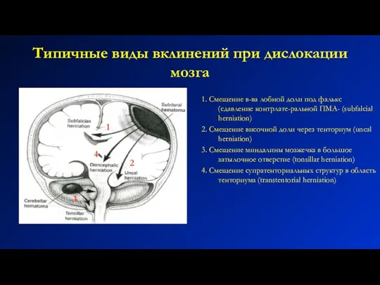 Типичные виды вклинений при дислокации мозга 1. Смещение в-ва лобной доли под