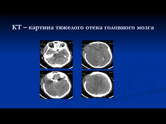 КТ – картина тяжелого отека головного мозга