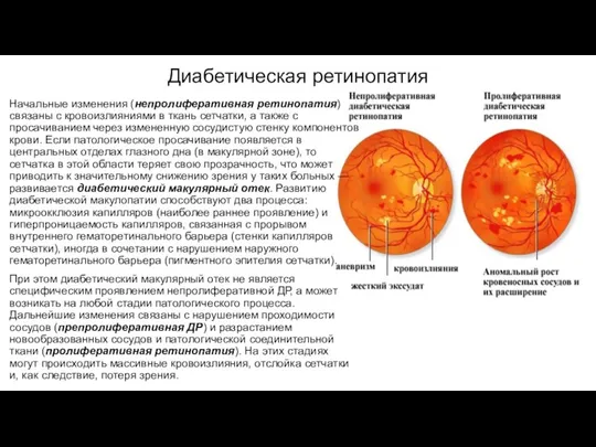 Диабетическая ретинопатия Начальные изменения (непролиферативная ретинопатия) связаны с кровоизлияниями в ткань сетчатки,