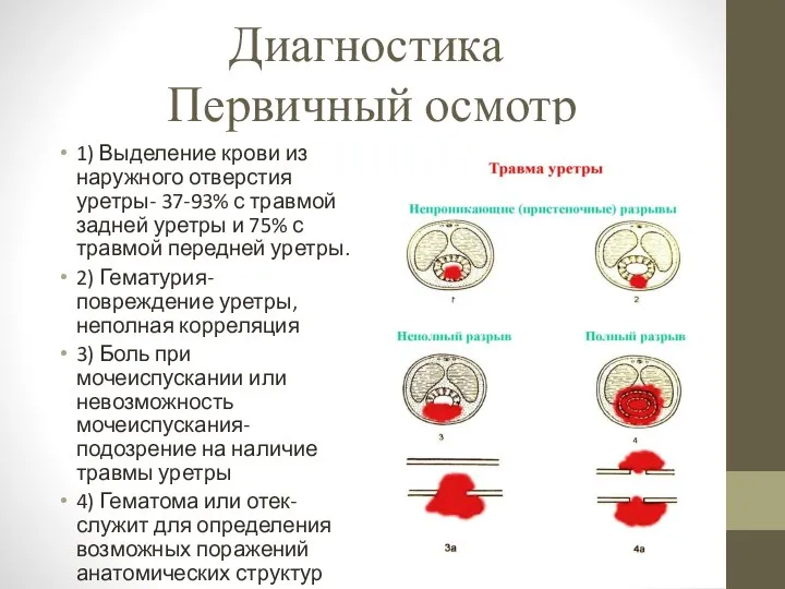 Диагностика Первичный осмотр 1) Выделение крови из наружного отверстия уретры- 37-93% с