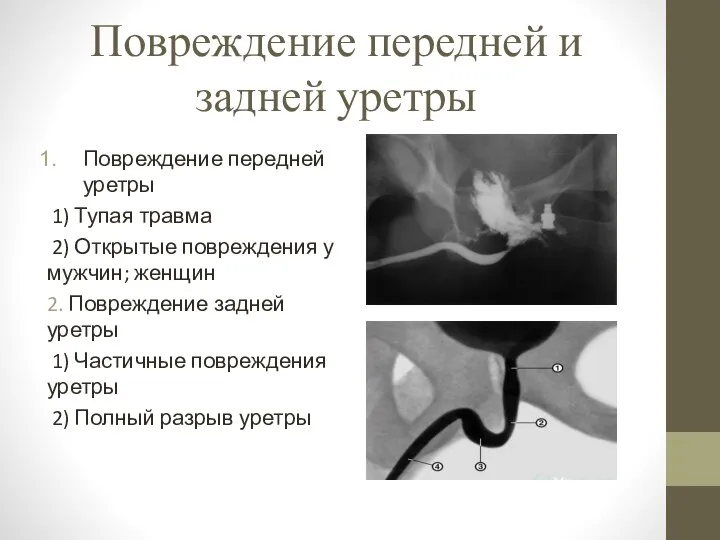 Повреждение передней и задней уретры Повреждение передней уретры 1) Тупая травма 2)