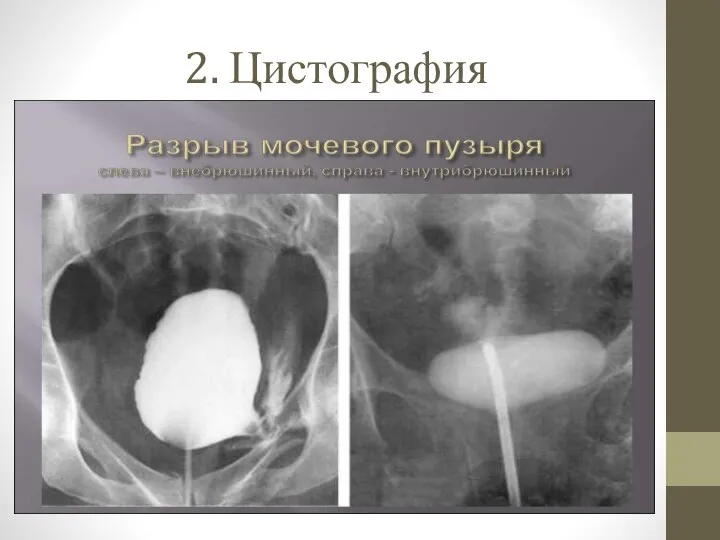 2. Цистография