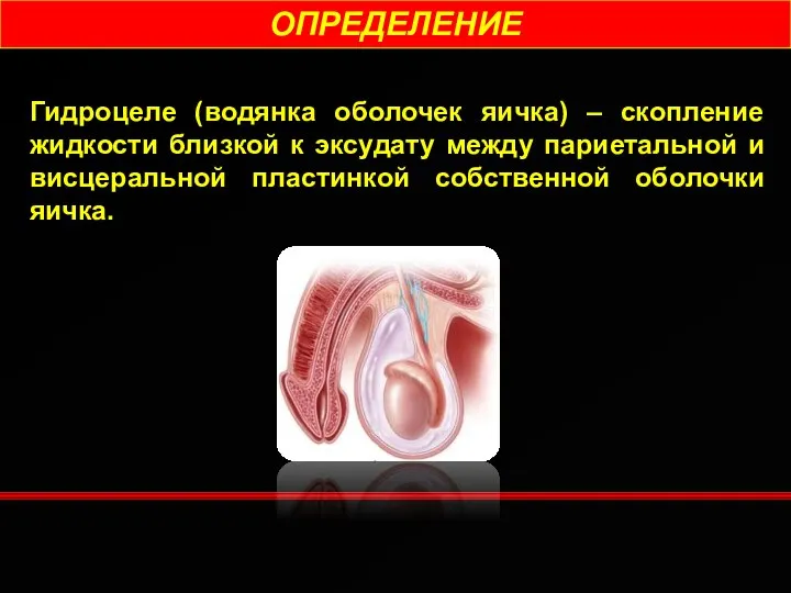 ОПРЕДЕЛЕНИЕ Гидроцеле (водянка оболочек яичка) – скопление жидкости близкой к эксудату между