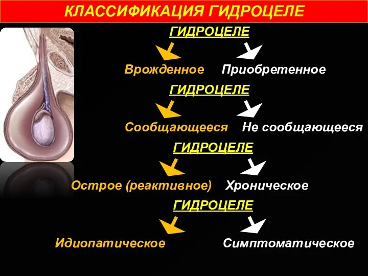 КЛАССИФИКАЦИЯ ГИДРОЦЕЛЕ ГИДРОЦЕЛЕ Врожденное Приобретенное ГИДРОЦЕЛЕ Сообщающееся Не сообщающееся ГИДРОЦЕЛЕ Острое (реактивное) Хроническое ГИДРОЦЕЛЕ Идиопатическое Симптоматическое