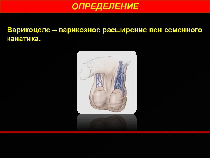 ОПРЕДЕЛЕНИЕ Варикоцеле – варикозное расширение вен семенного канатика.