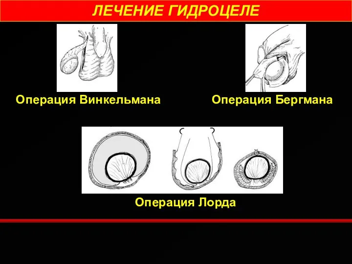 ЛЕЧЕНИЕ ГИДРОЦЕЛЕ Операция Винкельмана Операция Бергмана Операция Лорда