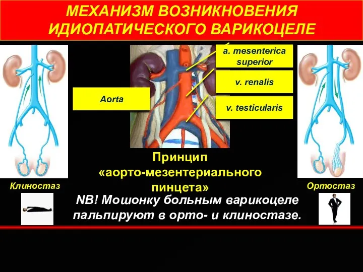 МЕХАНИЗМ ВОЗНИКНОВЕНИЯ ИДИОПАТИЧЕСКОГО ВАРИКОЦЕЛЕ Принцип «аорто-мезентериального пинцета» Клиностаз Ортостаз a. mesenterica superior