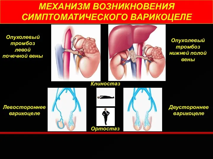 МЕХАНИЗМ ВОЗНИКНОВЕНИЯ СИМПТОМАТИЧЕСКОГО ВАРИКОЦЕЛЕ Опухолевый тромбоз левой почечной вены Опухолевый тромбоз нижней