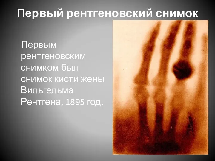 Первый рентгеновский снимок Первым рентгеновским снимком был снимок кисти жены Вильгельма Рентгена, 1895 год.