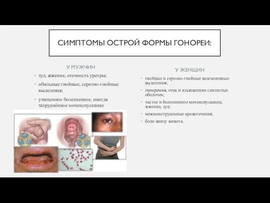 У МУЖЧИН зуд, жжение, отечность уретры; обильные гнойные, серозно-гнойные выделения; учащенное болезненное,