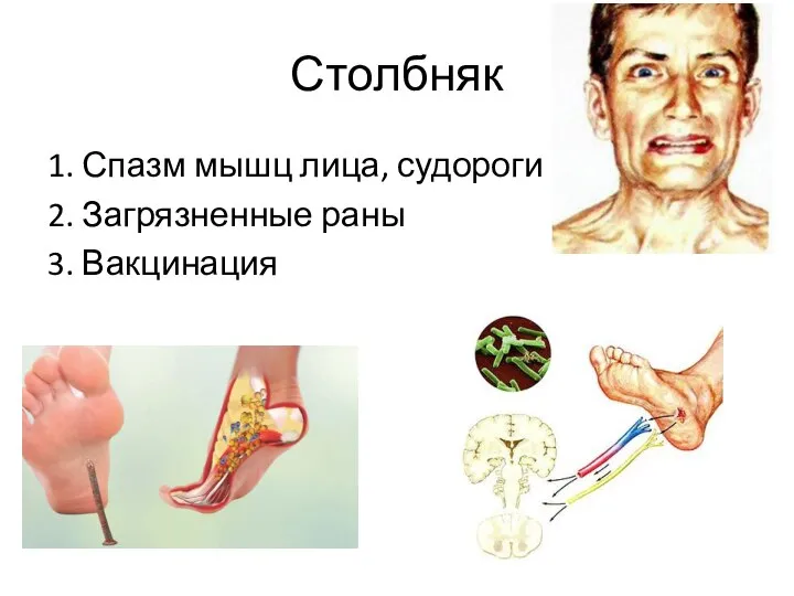 Столбняк 1. Спазм мышц лица, судороги 2. Загрязненные раны 3. Вакцинация