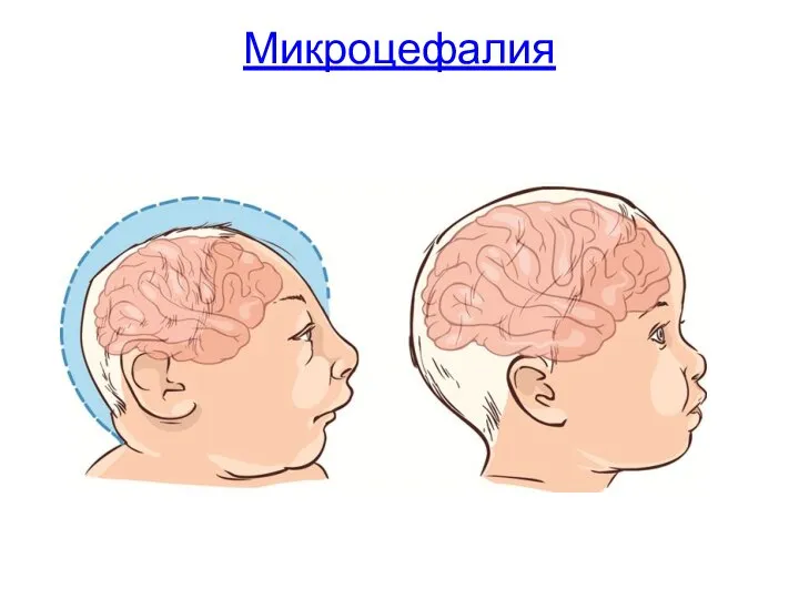 Микроцефалия