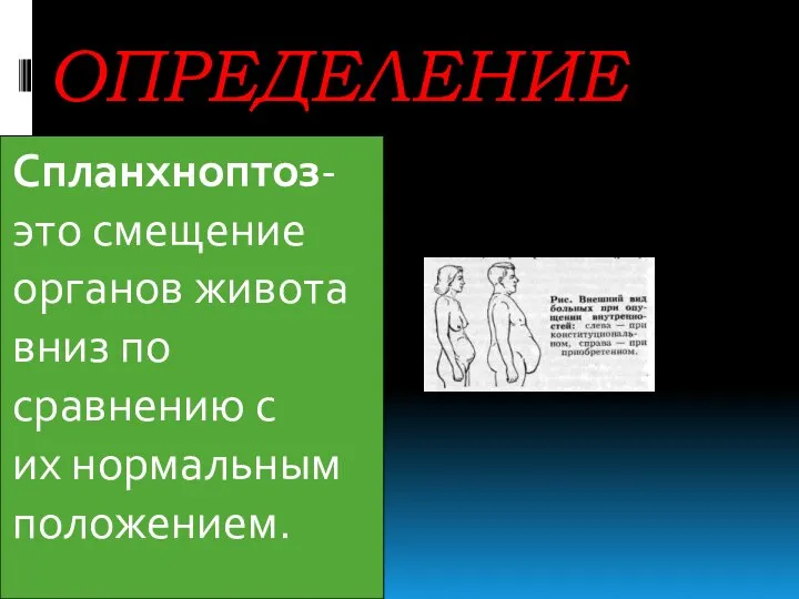 ОПРЕДЕЛЕНИЕ Спланхноптоз-это смещение органов живота вниз по сравнению с их нормальным положением.