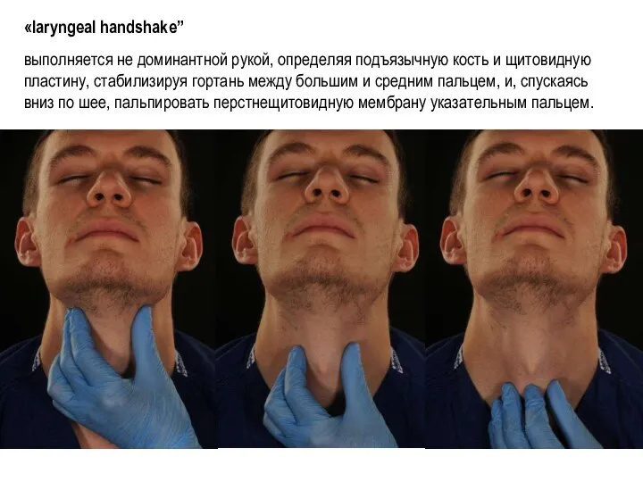 «laryngeal handshake” выполняется не доминантной рукой, определяя подъязычную кость и щитовидную пластину,