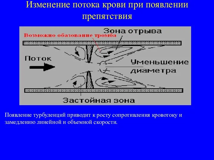 Изменение потока крови при появлении препятствия Появление турбуленций приводит к росту сопротивления