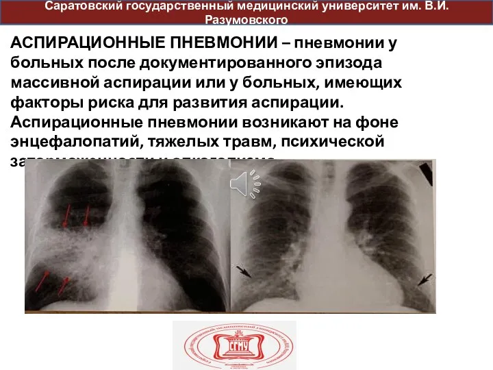 оо АСПИРАЦИОННЫЕ ПНЕВМОНИИ – пневмонии у больных после документированного эпизода массивной аспирации