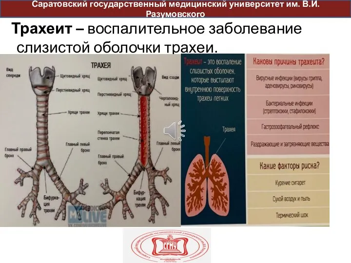 Трахеит – воспалительное заболевание слизистой оболочки трахеи. Саратовский государственный медицинский университет им. В.И. Разумовского