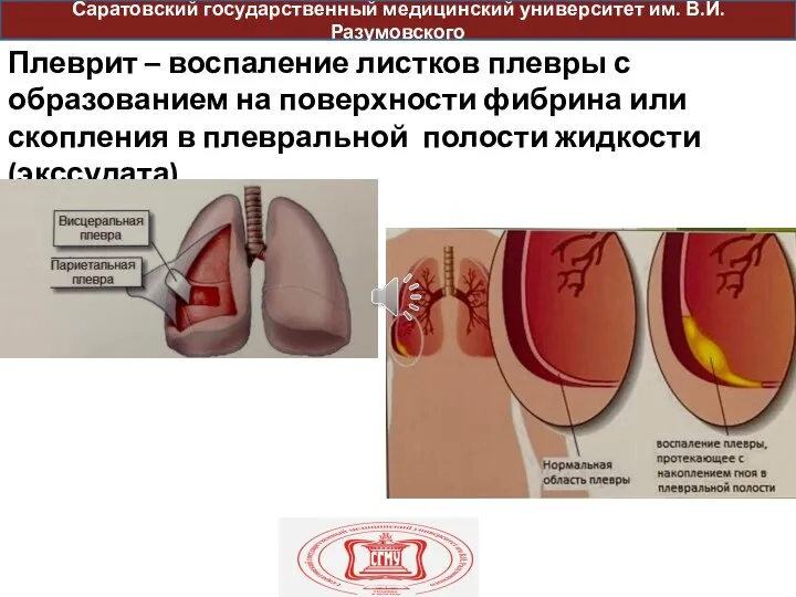 пр Плеврит – воспаление листков плевры с образованием на поверхности фибрина или