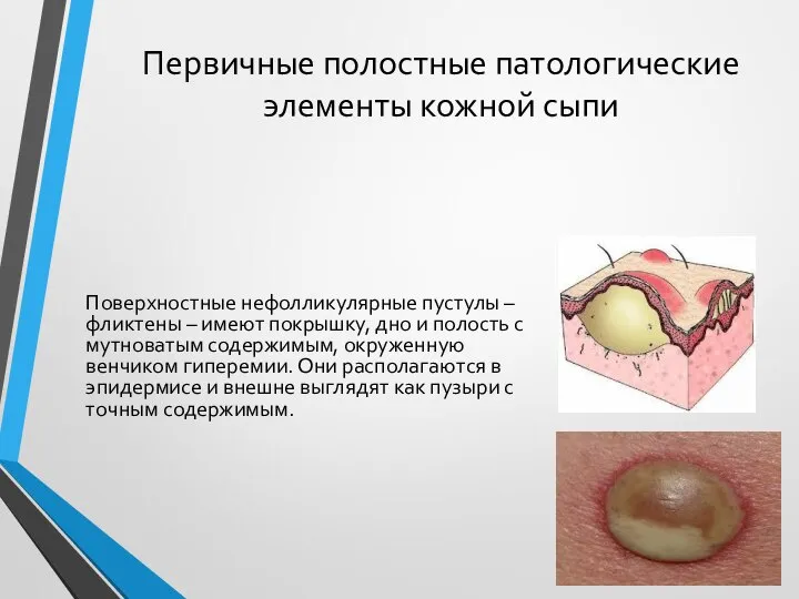 Первичные полостные патологические элементы кожной сыпи Поверхностные нефолликулярные пустулы – фликтены –