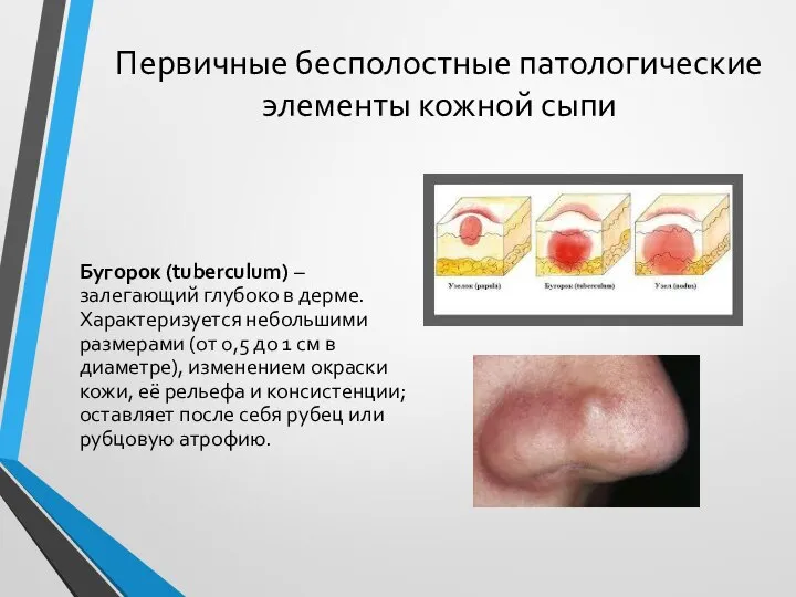 Первичные бесполостные патологические элементы кожной сыпи Бугорок (tuberculum) – залегающий глубоко в