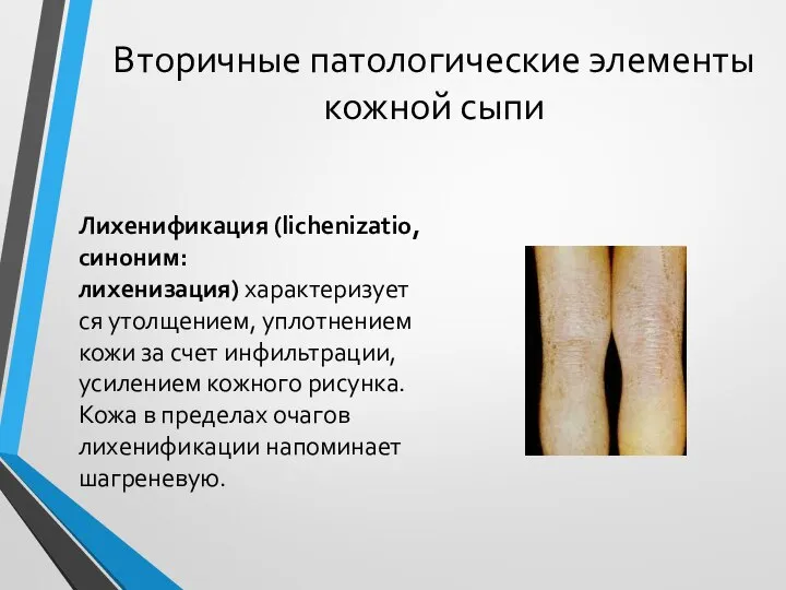 Вторичные патологические элементы кожной сыпи Лихенификация (lichenizatio, синоним: лихенизация) характеризуется утолщением, уплотнением