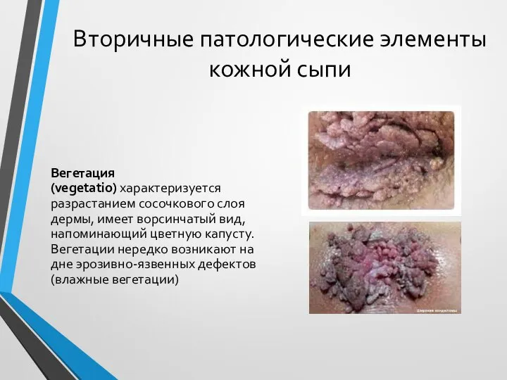 Вторичные патологические элементы кожной сыпи Вегетация (vegetatio) характеризуется разрастанием сосочкового слоя дермы,