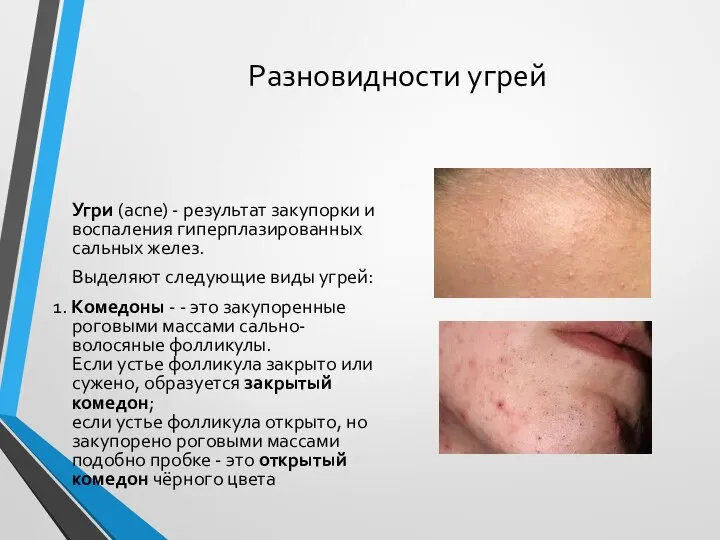 Разновидности угрей Угри (acne) - результат закупорки и воспаления гиперплазированных сальных желез.