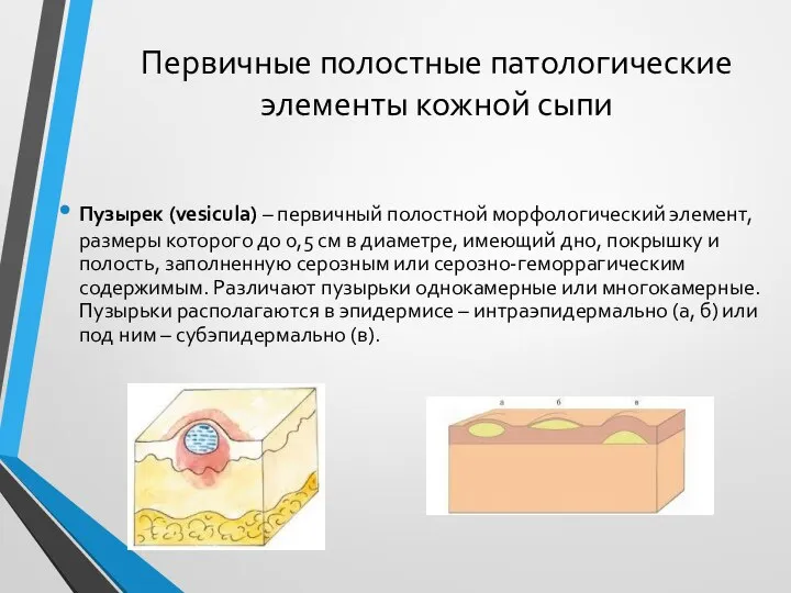 Первичные полостные патологические элементы кожной сыпи Пузырек (vesicula) – первичный полостной морфологический