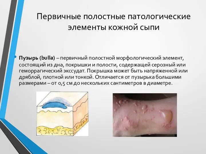 Первичные полостные патологические элементы кожной сыпи Пузырь (bulla) – первичный полостной морфологический