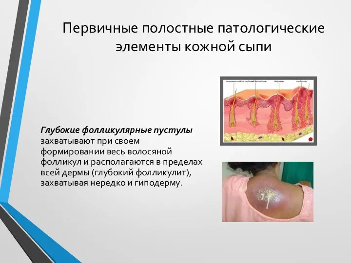 Первичные полостные патологические элементы кожной сыпи Глубокие фолликулярные пустулы захватывают при своем