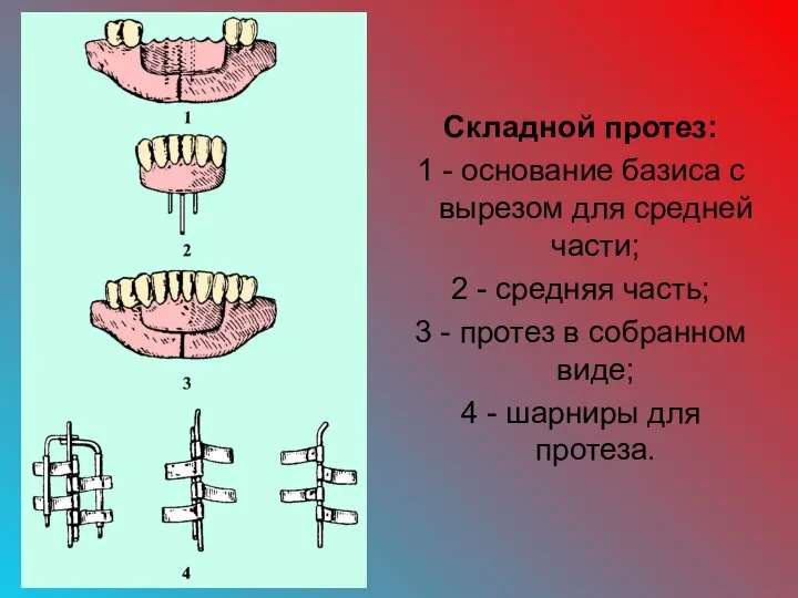 Складной протез: 1 - основание базиса с вырезом для средней части; 2