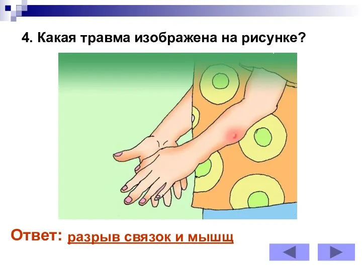 4. Какая травма изображена на рисунке? Ответ: разрыв связок и мышщ