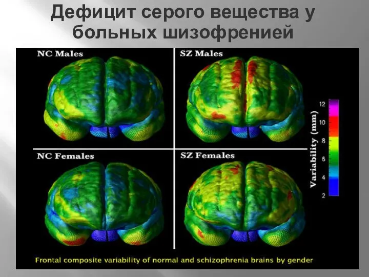 Дефицит серого вещества у больных шизофренией