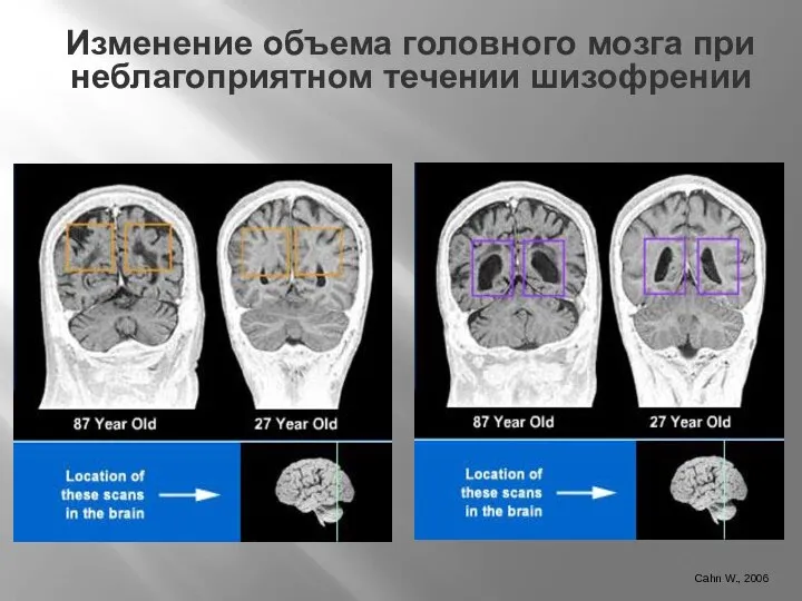 Cahn W., 2006 Изменение объема головного мозга при неблагоприятном течении шизофрении