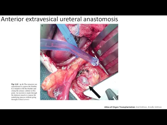 Anterior extravesical ureteral anastomosis Atlas of Organ Transplantation 2nd Edition, Kindle Edition 2015