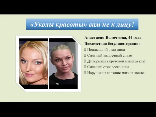 «Уколы красоты» вам не к лицу! Анастасия Волочкова, 44 года Последствия ботулинотерапии: