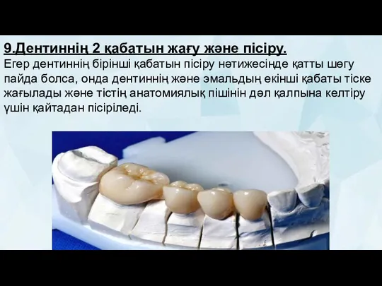 9.Дентиннің 2 қабатын жағу және пісіру. Егер дентиннің бірінші қабатын пісіру нәтижесінде