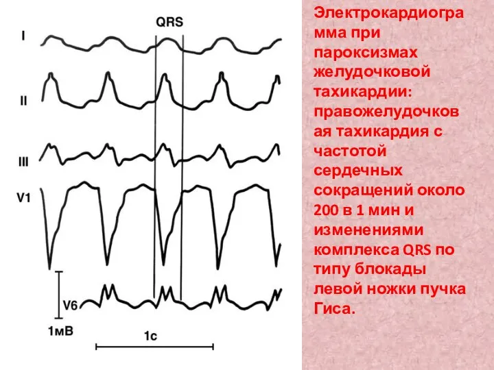 Электрокардиограмма при пароксизмах желудочковой тахикардии: правожелудочковая тахикардия с частотой сердечных сокращений около