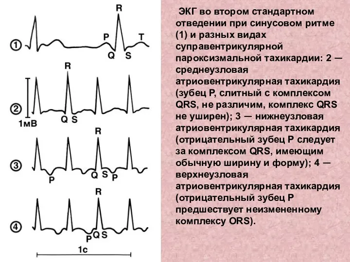 ЭКГ во втором стандартном отведении при синусовом ритме (1) и разных видах