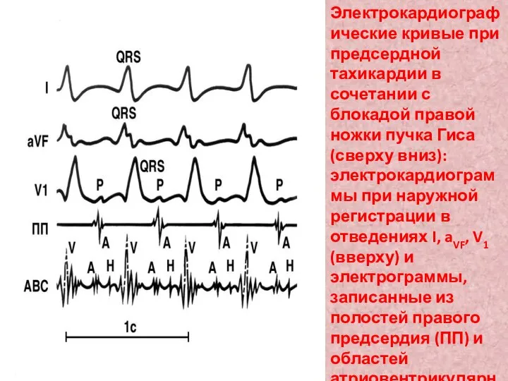 Электрокардиографические кривые при предсердной тахикардии в сочетании с блокадой правой ножки пучка