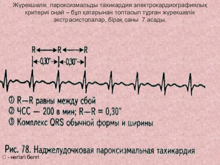 ? - негізгі белгі Жүрекшелік пароксизмальды тахикардия электрокардиографиялық критериі оңай – бұл