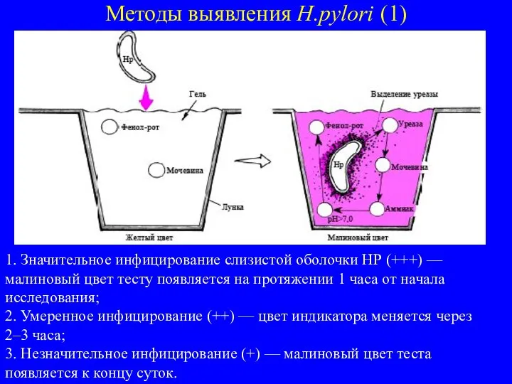 Методы выявления H.pylori (1) 1. Значительное инфицирование слизистой оболочки НР (+++) —