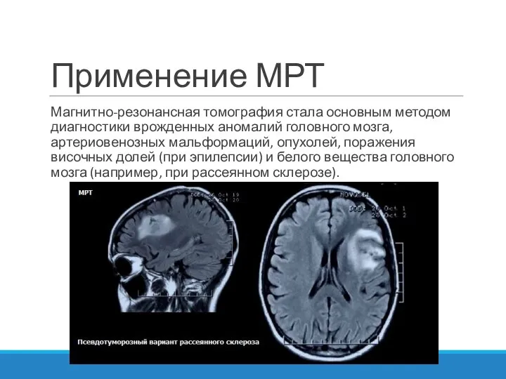 Применение МРТ Магнитно-резонансная томография стала основным методом диагностики врожденных аномалий головного мозга,