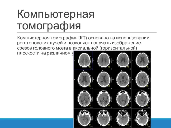 Компьютерная томография Компьютерная томография (КТ) основана на использовании рентгеновских лучей и позволяет