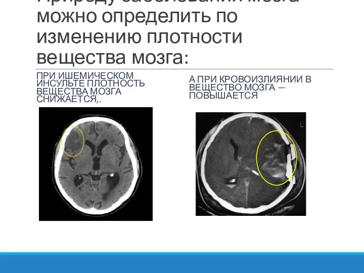 Природу заболевания мозга можно определить по изменению плотности вещества мозга: ПРИ ИШЕМИЧЕСКОМ