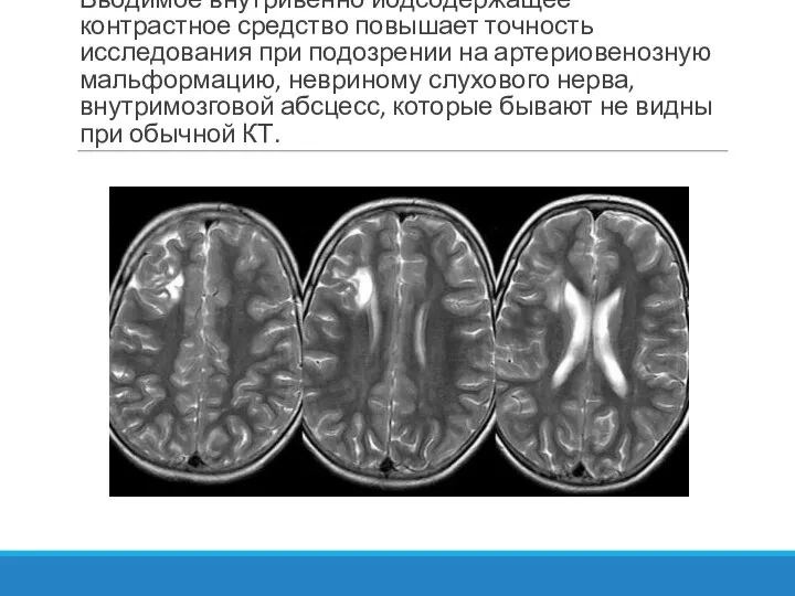 Вводимое внутривенно йодсодержащее контрастное средство повышает точность исследования при подозрении на артериовенозную